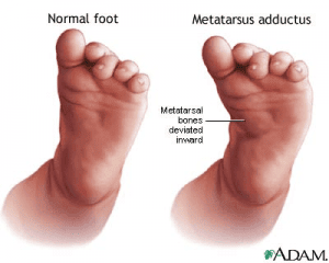 The difference between normal feet and metatarsus adductus